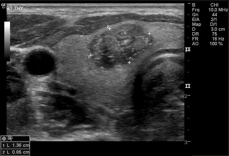 Thyroid Ultrasound